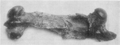 Fig. 47&mdash;Same bone as in Fig. 46 after about six months'
treatment. In this case Dr. Merillat employed a weight to counteract
muscular contraction. It is noticeable that very little provisional
callus has formed in this case, and in spite of unusual ingenuity and
good facilities for caring for the subject, union of bone did not
occur.