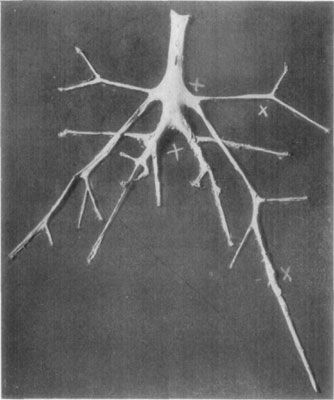 Fig. 48&mdash;Exposure of aorta and its branches, showing
location of thrombi in numerous places. In this case (same as Fig. 49)
Dr. L.A. and Dr. Edward Merillat found the cause of the condition to be
due to sclerastomiasis.