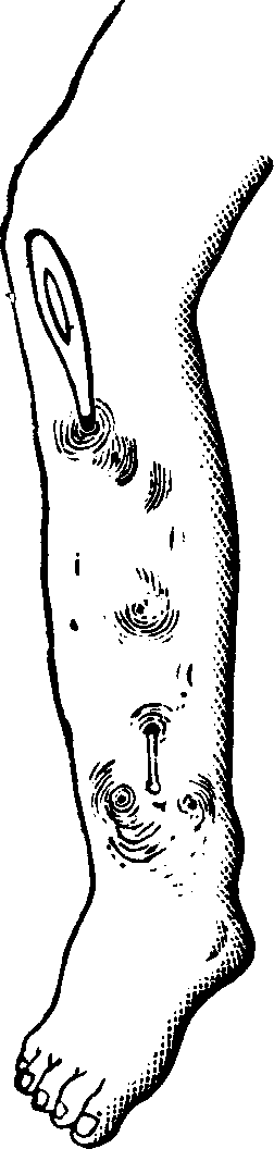 Illustration:
Fig. 6. Necrosis of the tibia. A common probe is passed through the
sinuses, or openings.