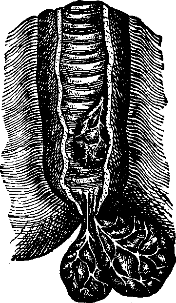 Illustration:
Fig. 2. Piles: internal and protruding. 