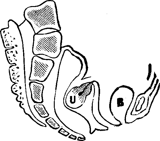 Illustration:
Fig. 13. Retroversion. B, Bladder. U, Uterus (Womb).