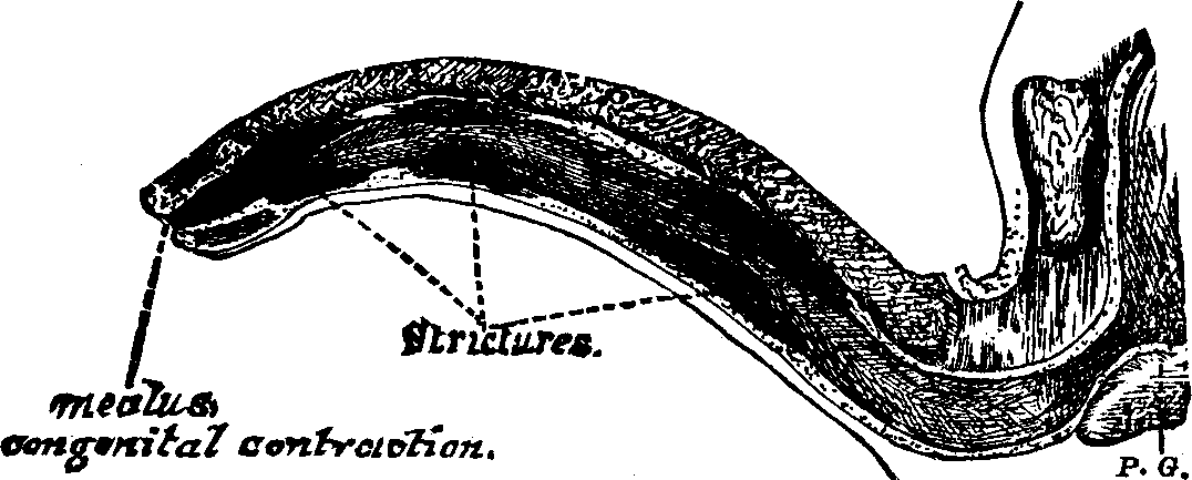 Illustration:
Fig. 3. Condition of the Urethra with three Strictures and a congenital
contraction at the meatus or outlet.