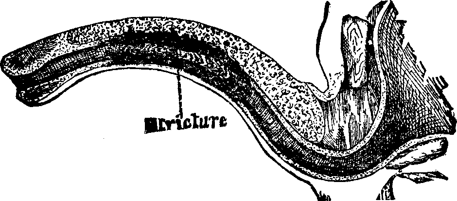 Illustration:
Fig. 4. Condition of the urethra in Case 112,289; permanently cured at the
Invalids' Hotel and Surgical Institute.