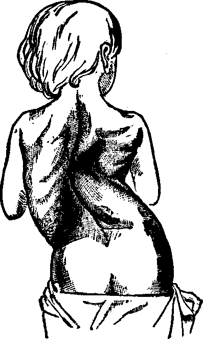 Illustration:
Fig. 9. Lateral curvature in an advanced stage. 