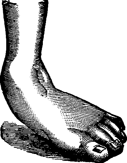 Illustration:
Fig. 12. Talipes Valgus.