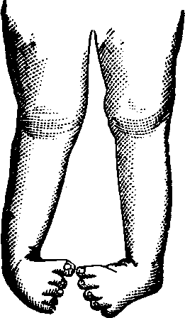 Illustration:
Fig. 13. Double Club-foot.