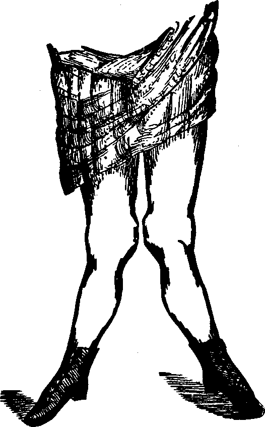 Illustration:
Fig. 15. Knock-knees.