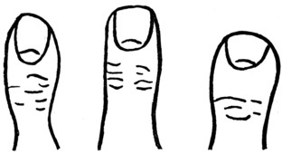 Fig. 4.&mdash;THE WAIST-LIKE THUMB. Fig. 5.&mdash;THE STRAIGHT THUMB. Fig. 6.&mdash;THE ELEMENTARY THUMB.