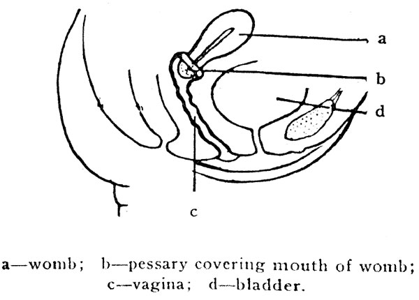 a&mdash;womb; b&mdash;pessary covering mouth of womb; c&mdash;vagina;
d&mdash;bladder.
