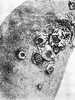 95. Chiggers in the sole of foot of man. Manson's
Tropical Diseases. Permission of Cassell and Co.