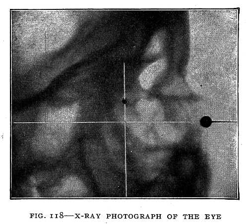 FIG. 118&ndash;X-RAY PHOTOGRAPH OF THE EYE