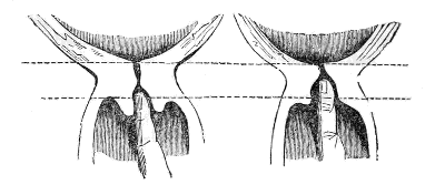 neck of
the Womb