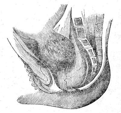 Case of
Polypus